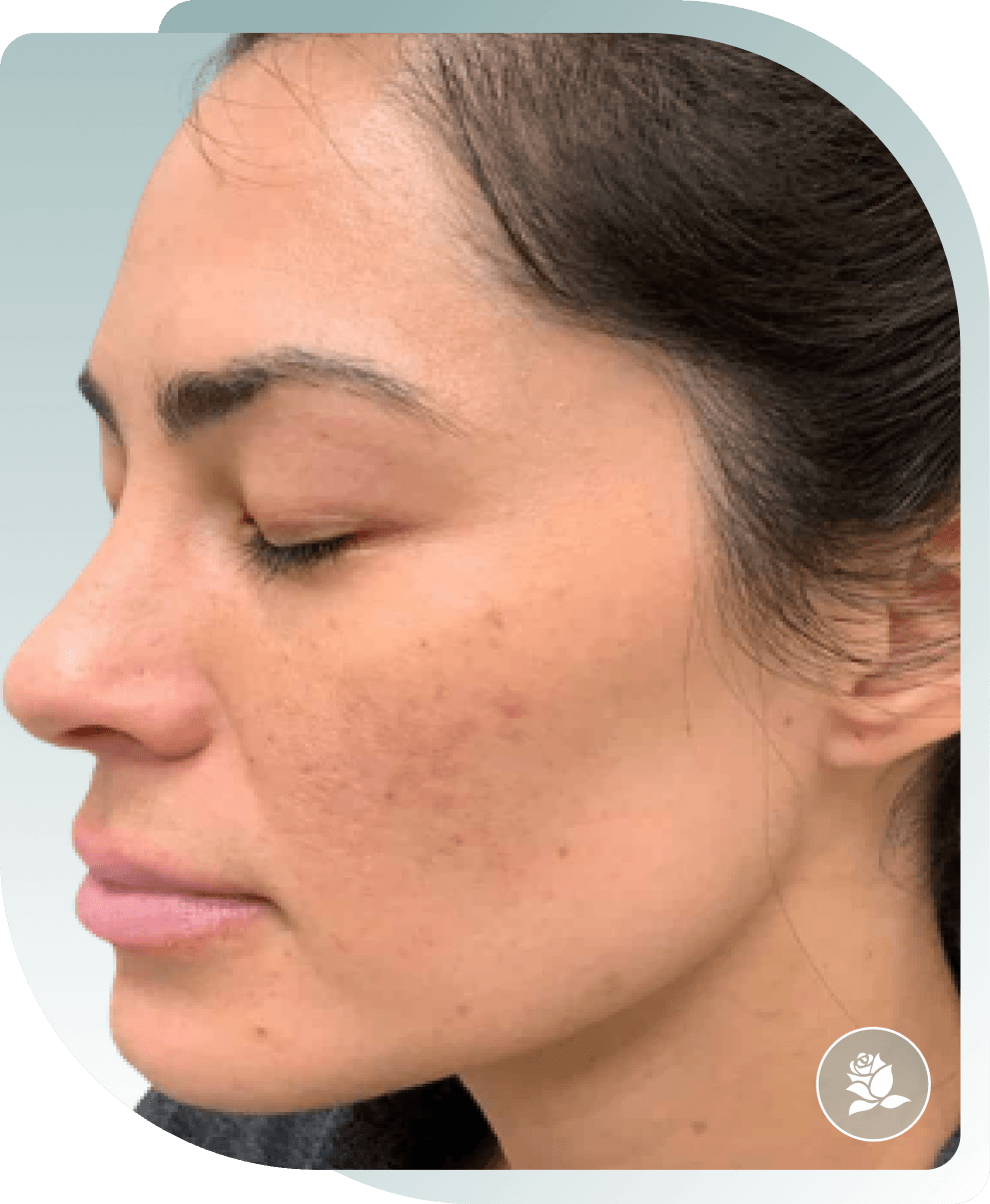 Hyperpigmentation — Before photo (result 3 of 5)
