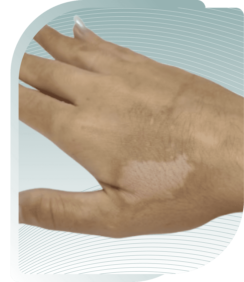 Age Spots on Hands — After photo (result 4 of 5)