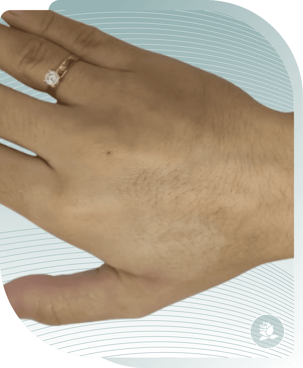 Age Spots on Hands — Before photo (result 4 of 5)