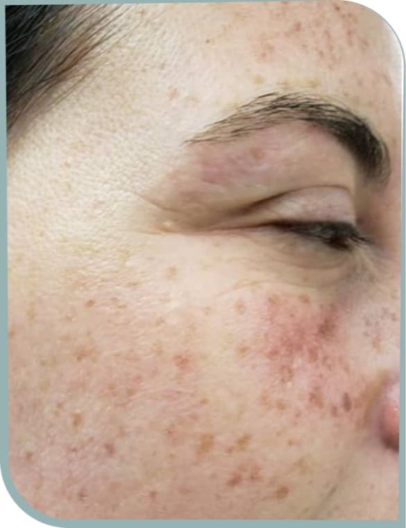 Eye area pigmentation, Before photo (result 5 of 10)