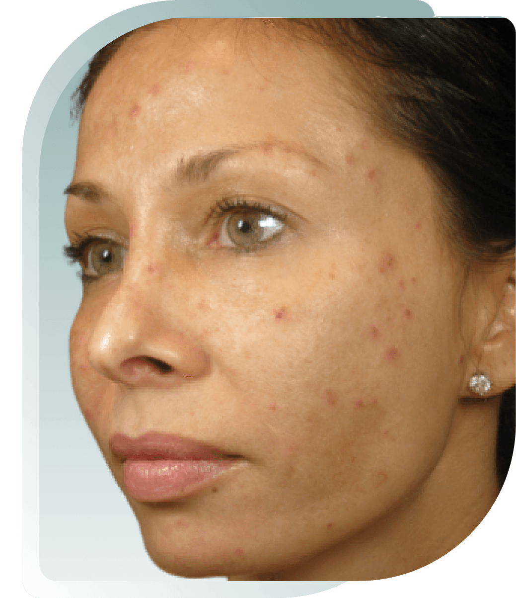 Uneven Tone & Texture — After photo (result 5 of 5)