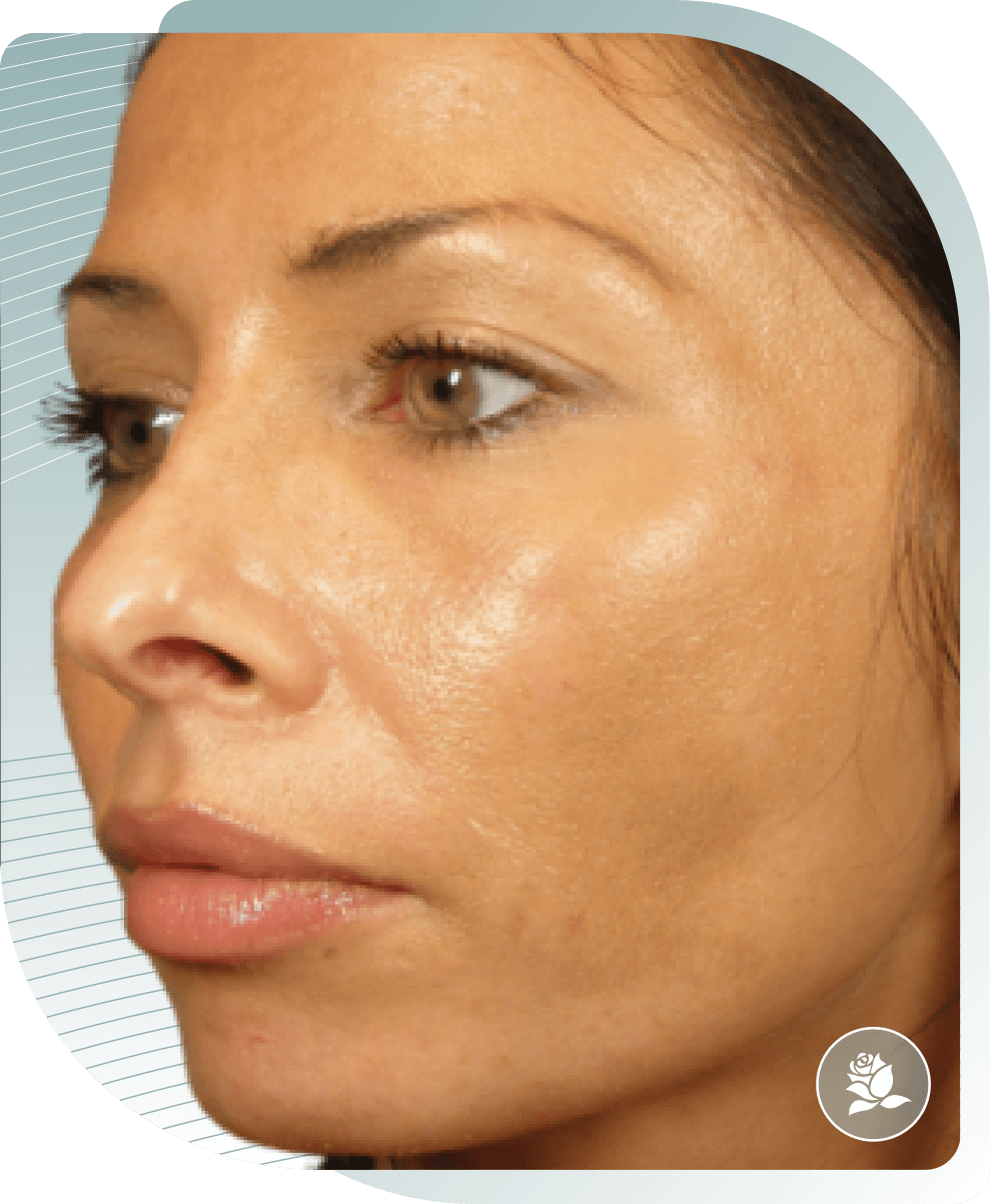 Uneven Tone & Texture — Before photo (result 5 of 5)
