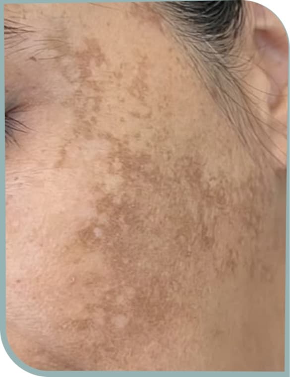 Cheek melasma, Before photo (result 7 of 10)