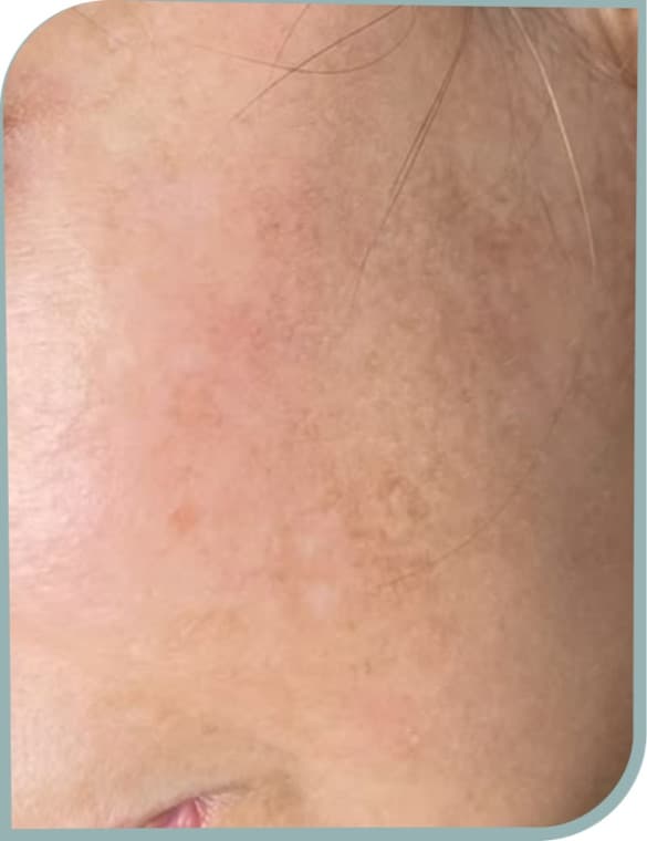Cheek melasma, After photo (result 7 of 10)