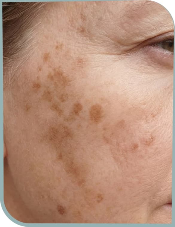 Sun spots, Before photo (result 9 of 10)