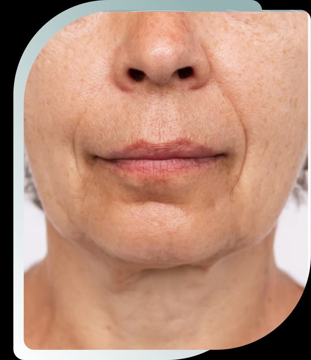 Before photo: Collagen Stimulator result at Carisma Aesthetics Malta