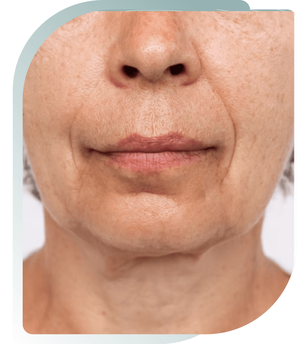 COLLAGEN STIMULATOR RESULTS — Before photo (result 1 of 5)