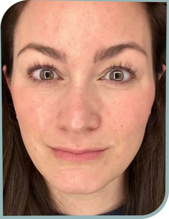 Skin quality, After photo (result 2 of 10)