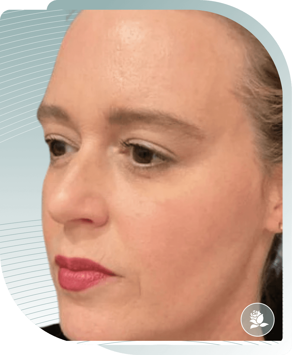 COLLAGEN STIMULATOR RESULTS — After photo (result 2 of 5)