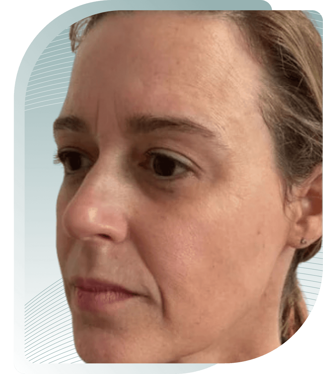 COLLAGEN STIMULATOR RESULTS — Before photo (result 2 of 5)