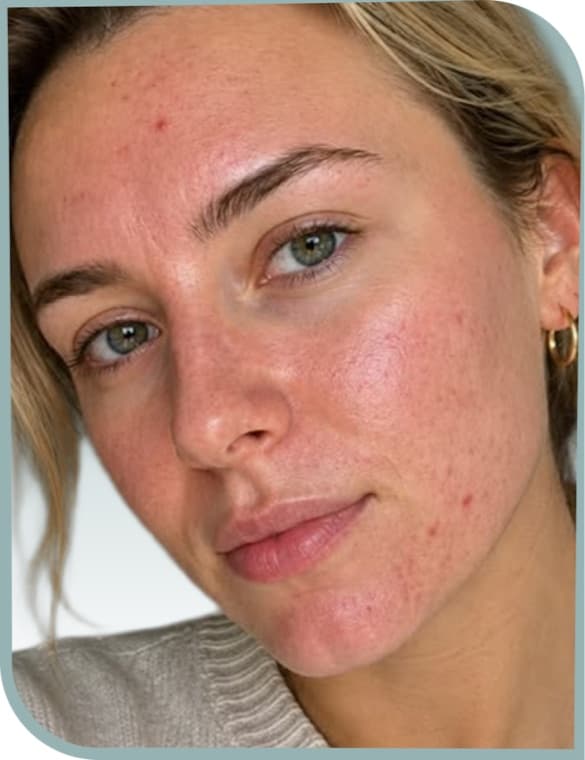 Cheek texture, Before photo (result 3 of 10)