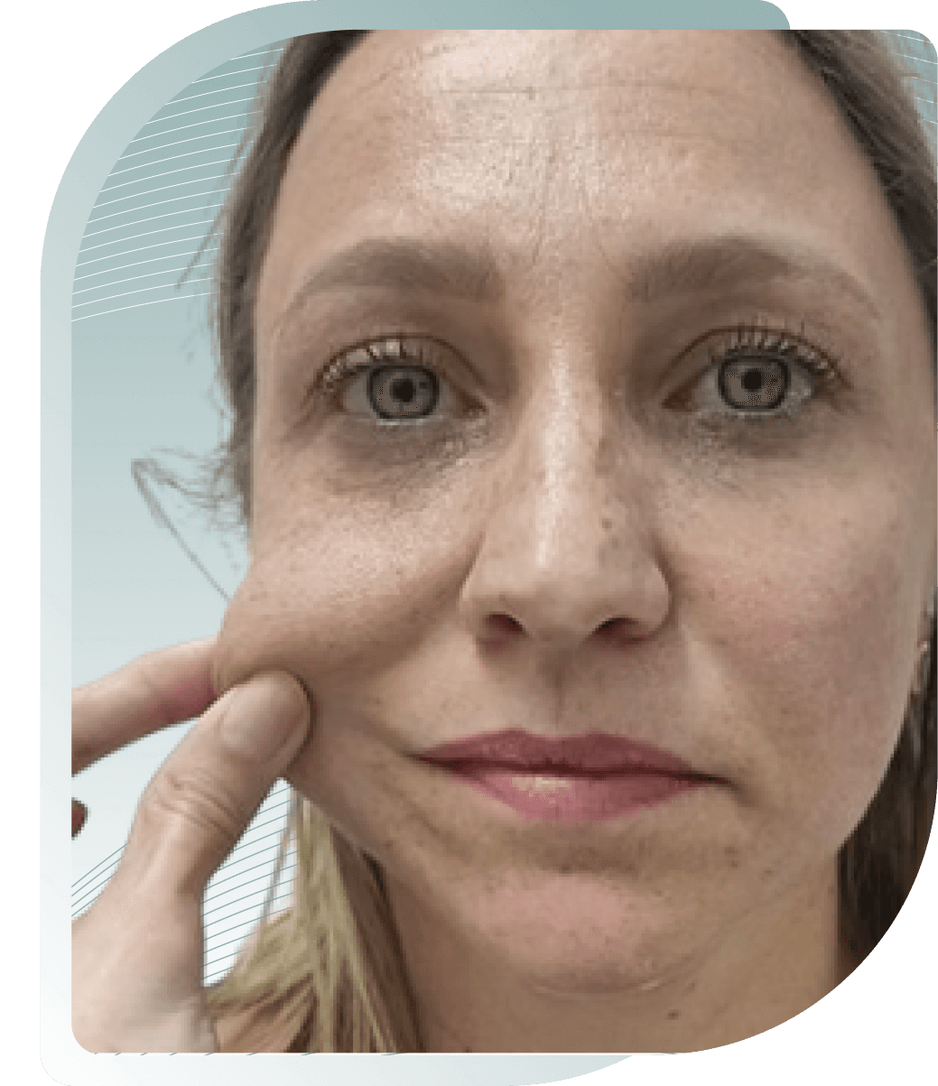 COLLAGEN STIMULATOR RESULTS — After photo (result 3 of 5)