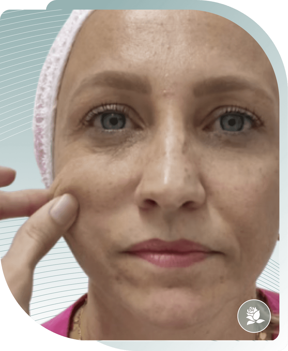 COLLAGEN STIMULATOR RESULTS — Before photo (result 3 of 5)