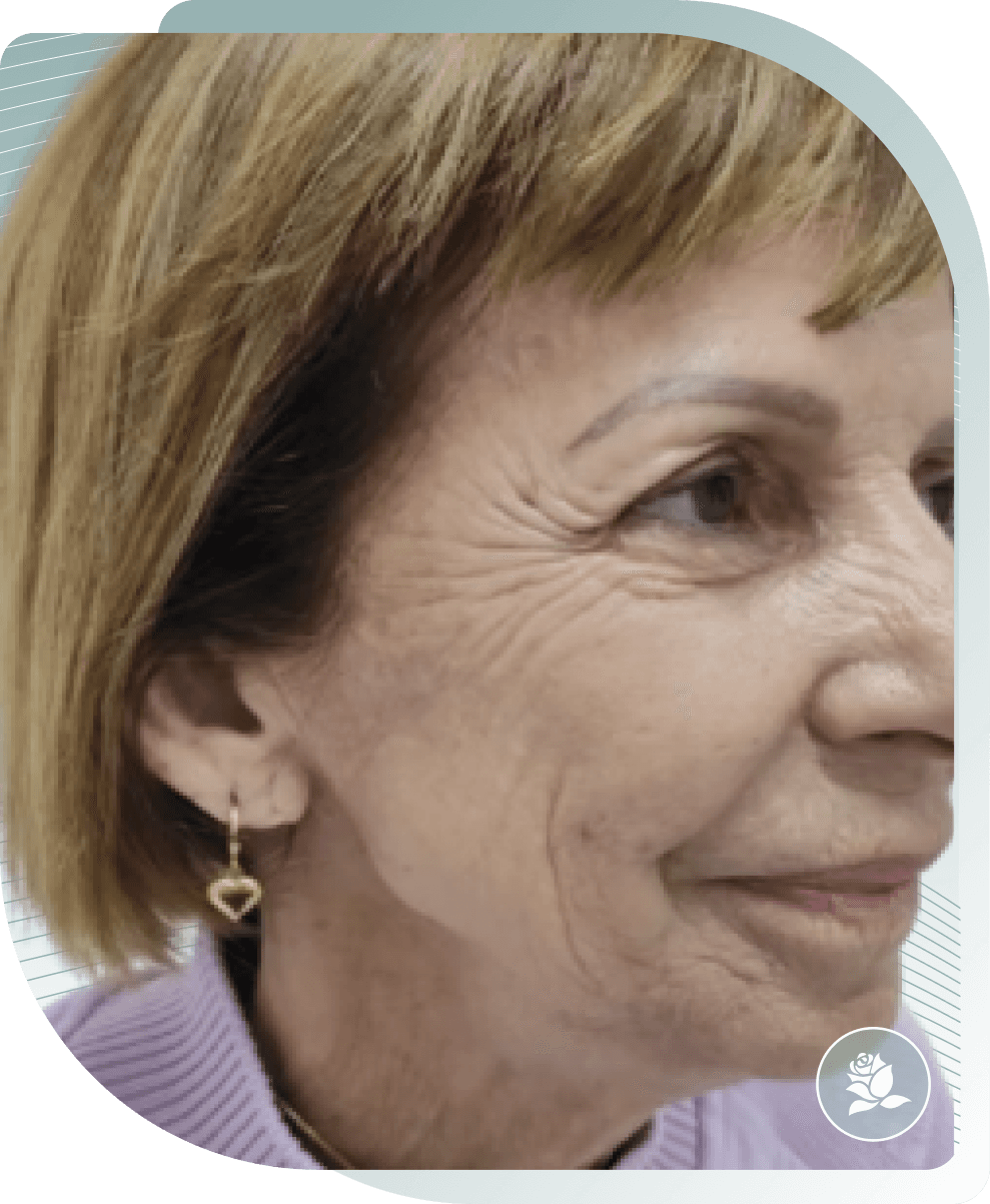 COLLAGEN STIMULATOR RESULTS — After photo (result 4 of 5)