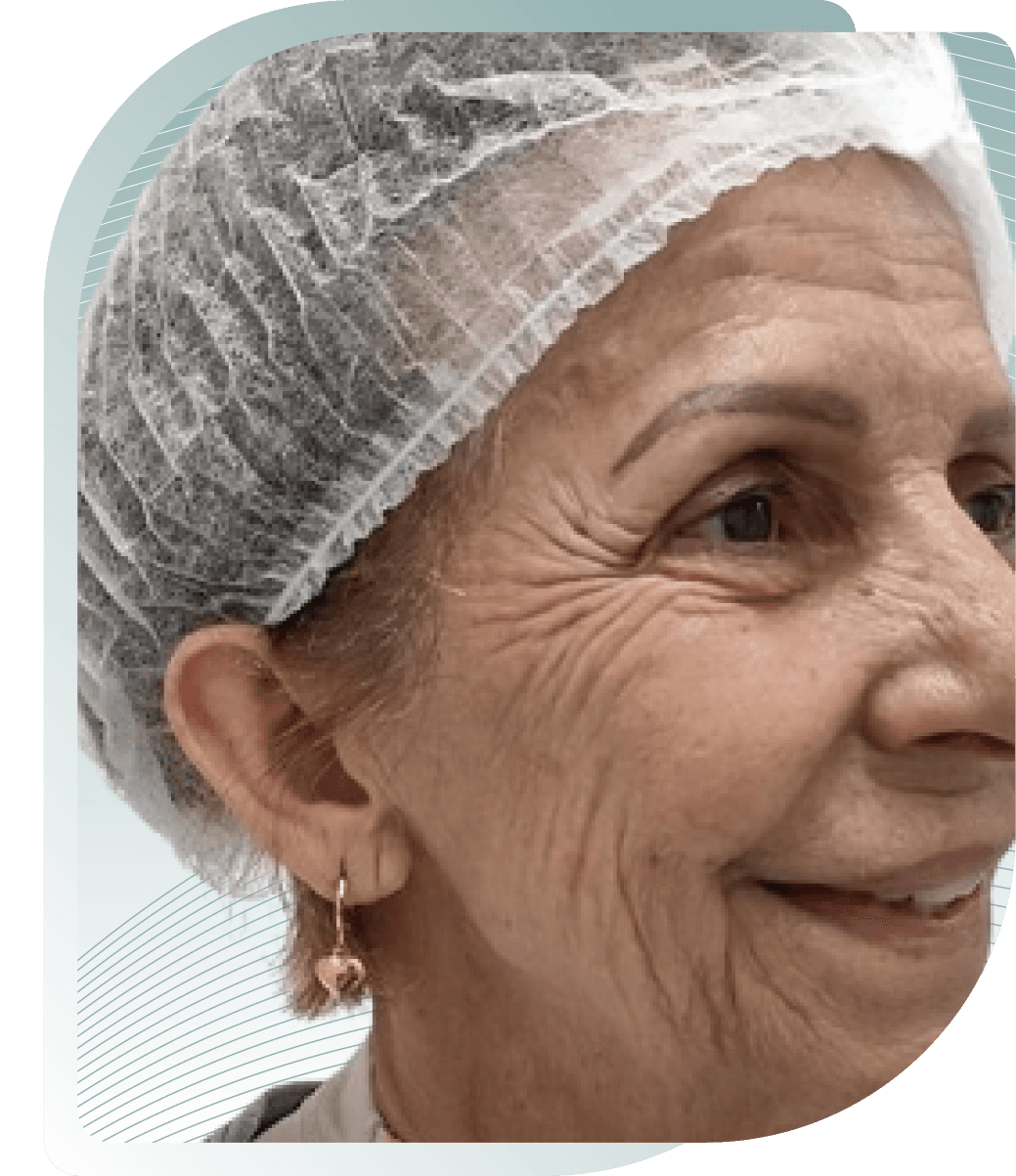 COLLAGEN STIMULATOR RESULTS — Before photo (result 4 of 5)