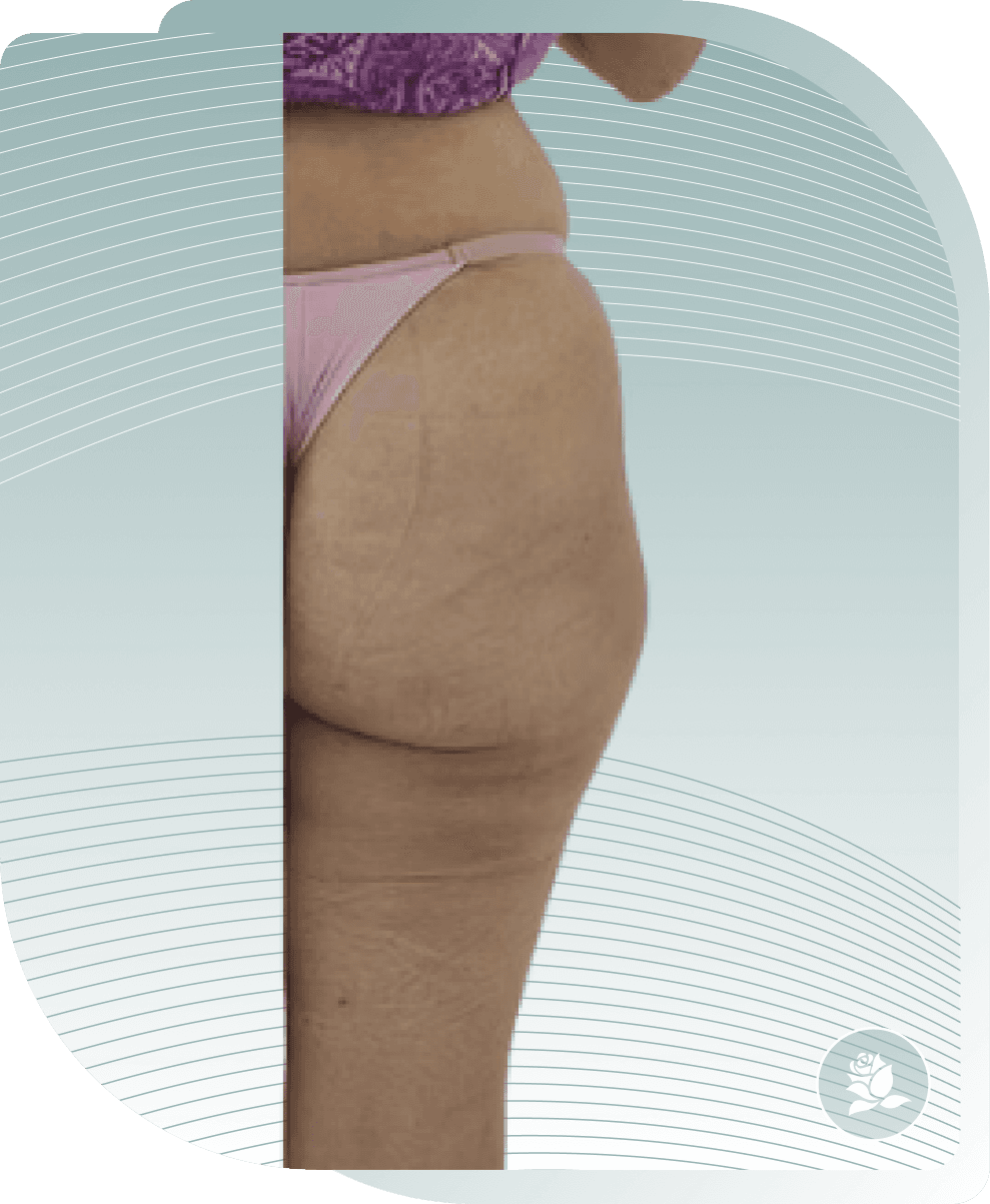 COLLAGEN STIMULATOR RESULTS — After photo (result 5 of 5)