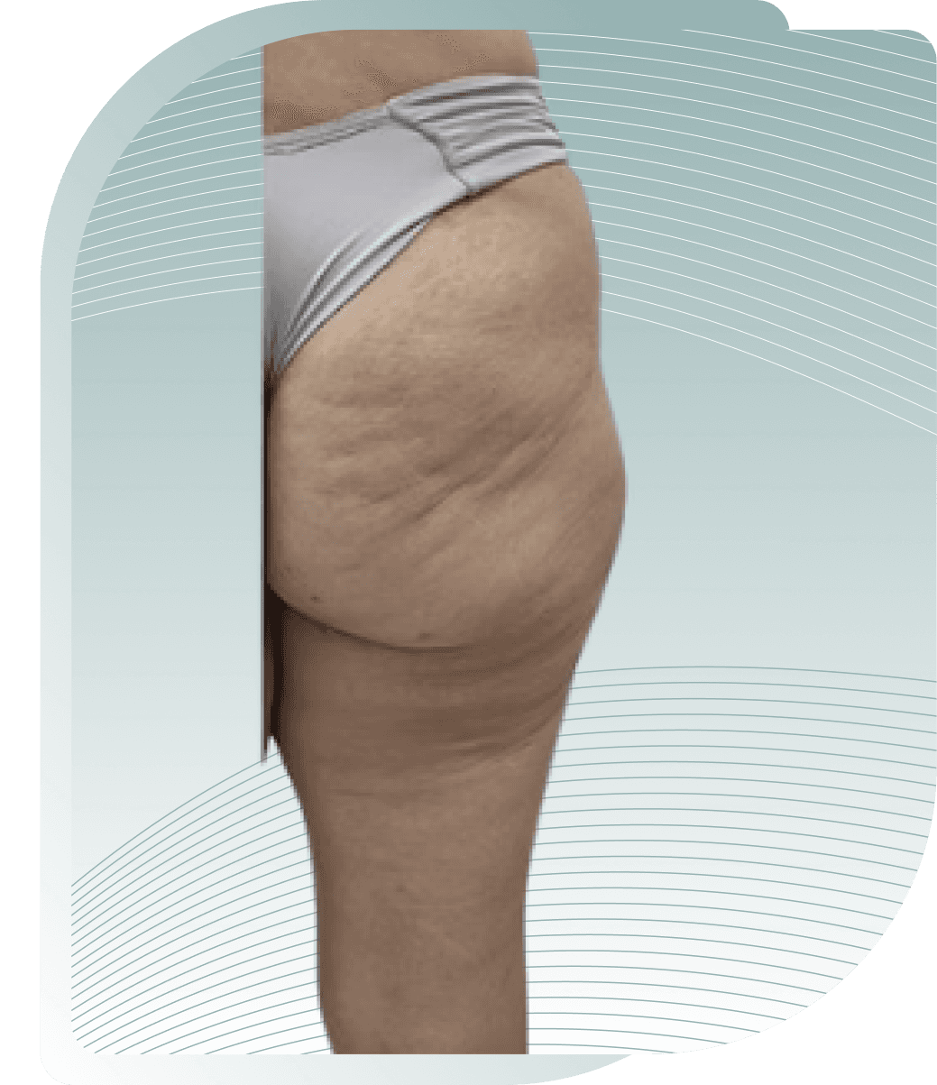 COLLAGEN STIMULATOR RESULTS — Before photo (result 5 of 5)