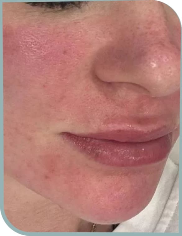 Cheek pores, Before photo (result 9 of 10)