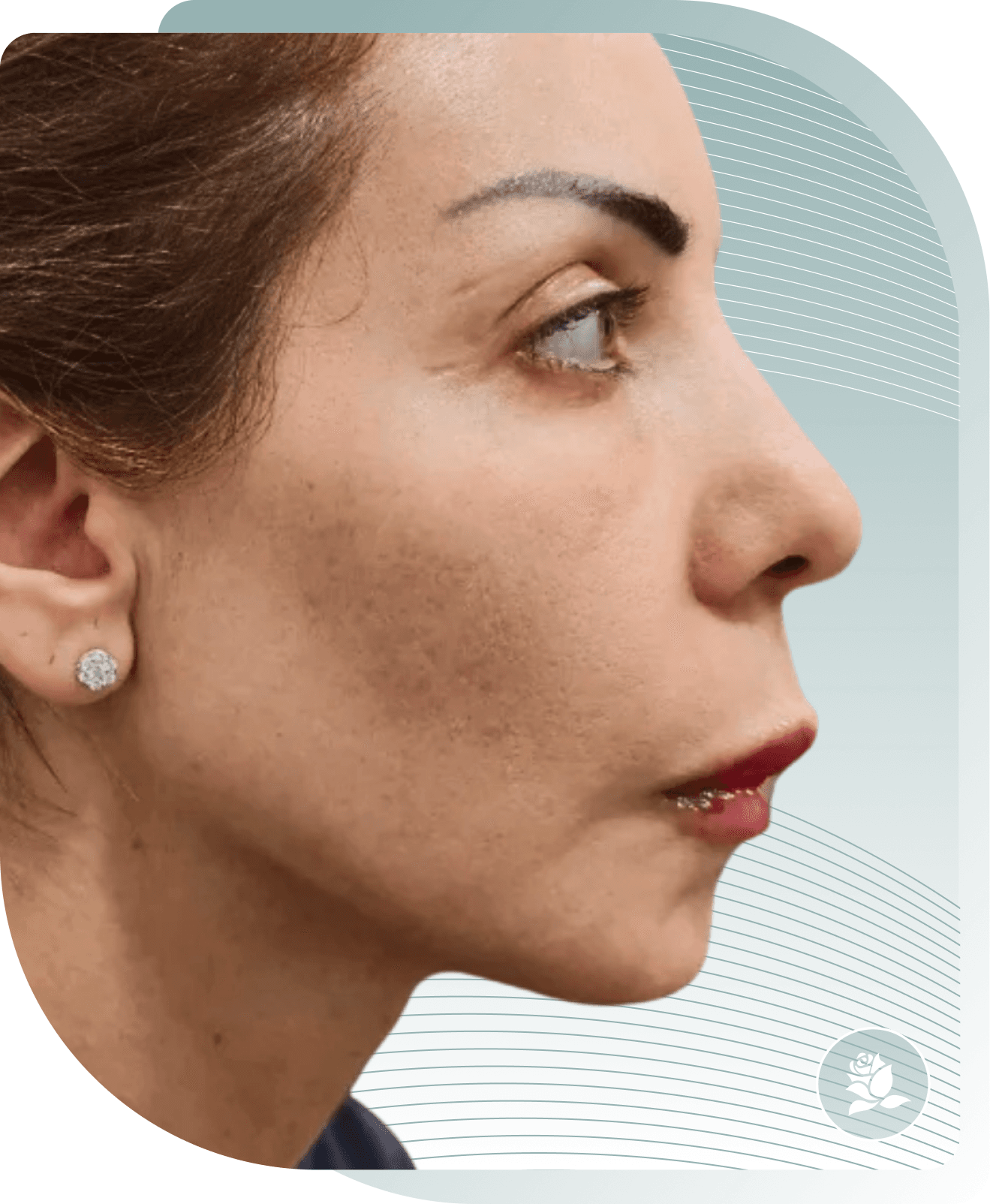 After photo: Dermal Fillers result at Carisma Aesthetics Malta