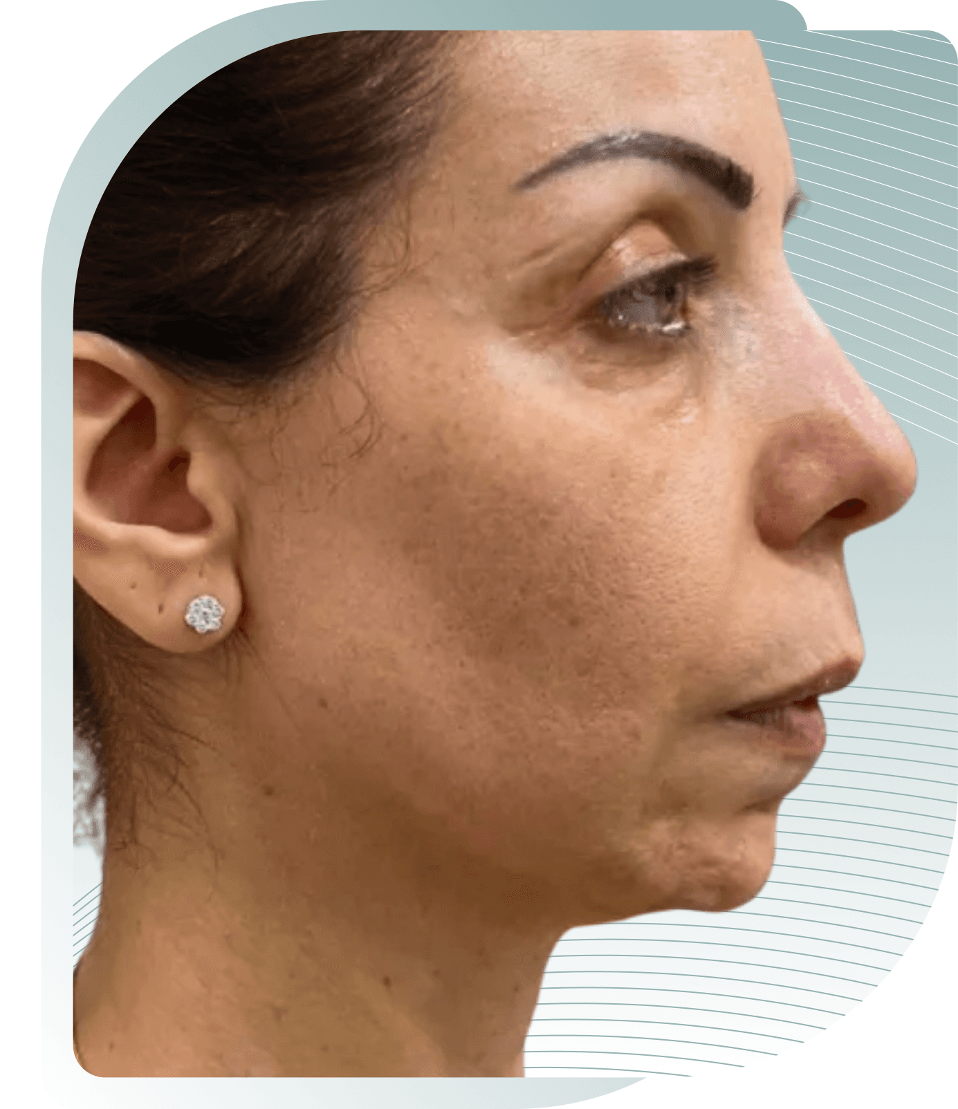 Before photo: Dermal Fillers result at Carisma Aesthetics Malta