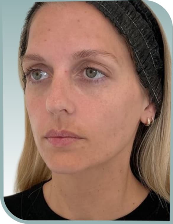 Lip volume, Before photo (result 10 of 10)