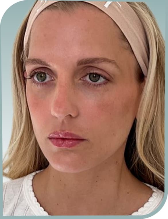 Lip volume, After photo (result 10 of 10)
