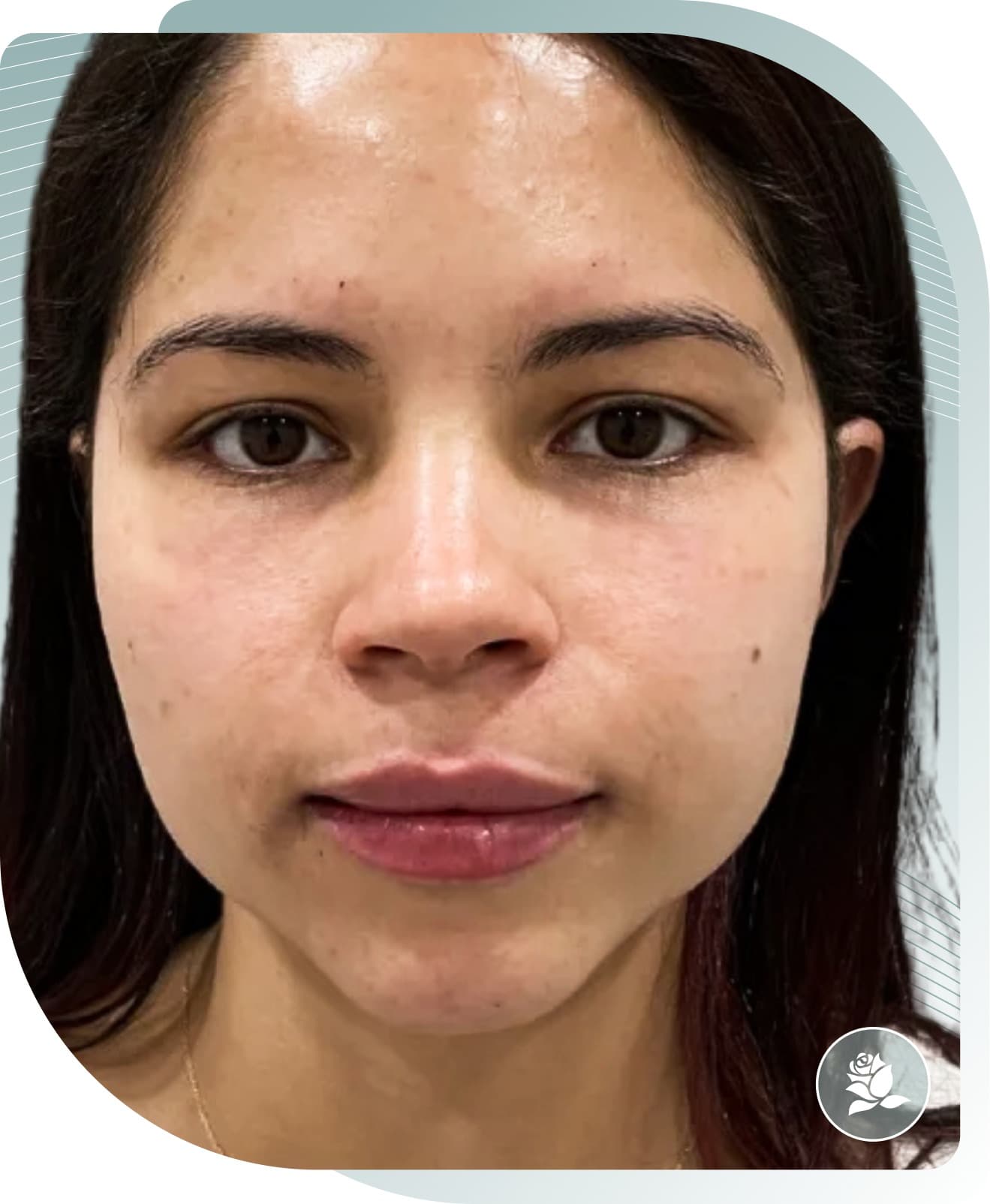 Cheek Volume Restoration — After photo (result 2 of 4)