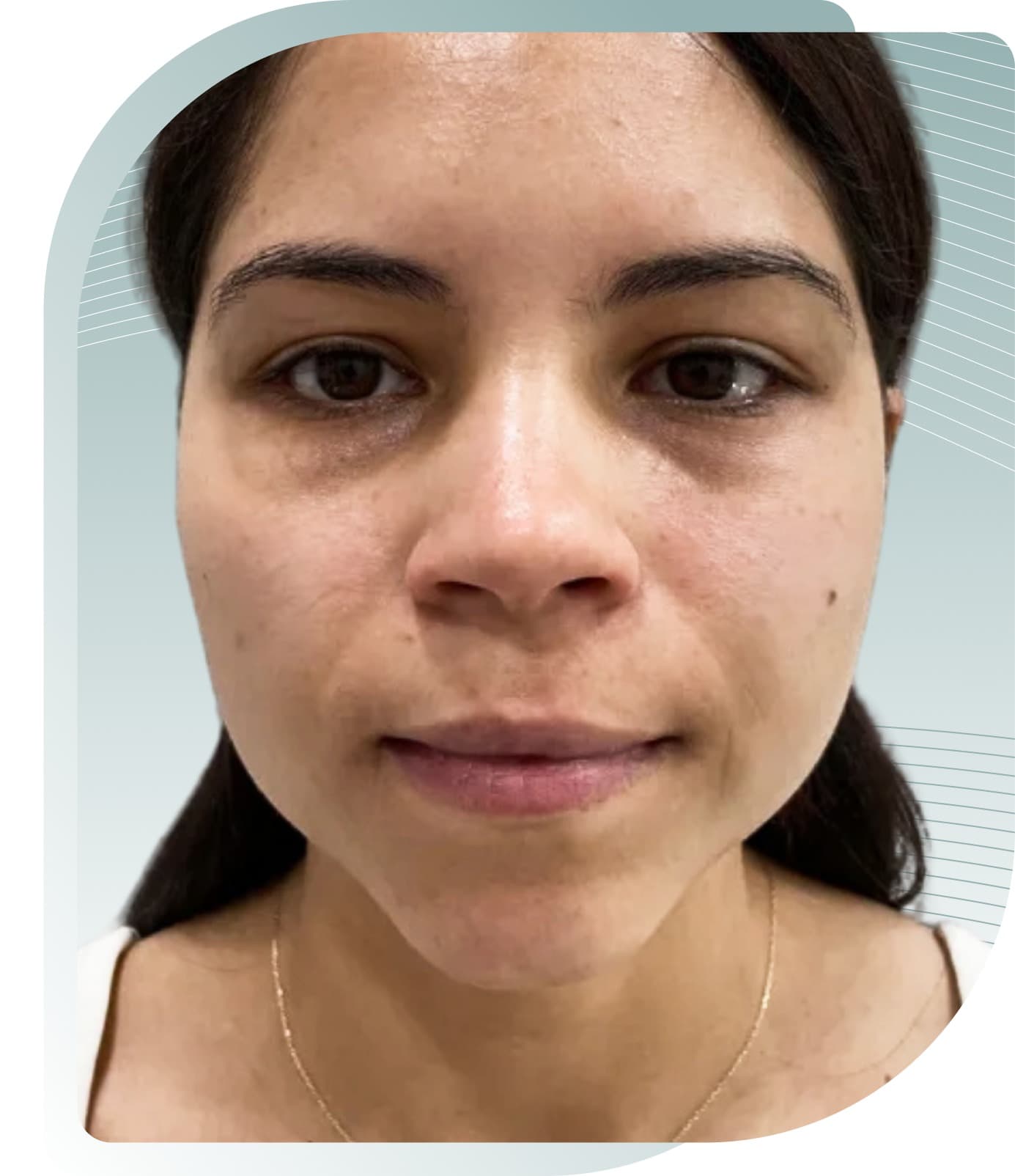 Cheek Volume Restoration — Before photo (result 2 of 4)