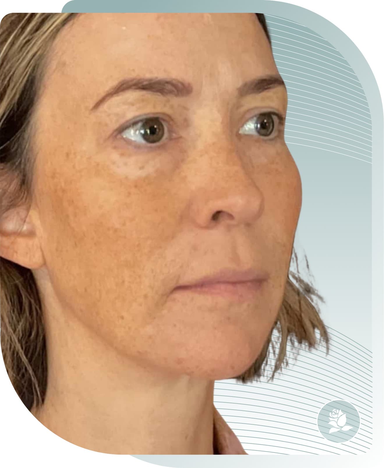 Mid-Face Rejuvenation — After photo (result 3 of 4)