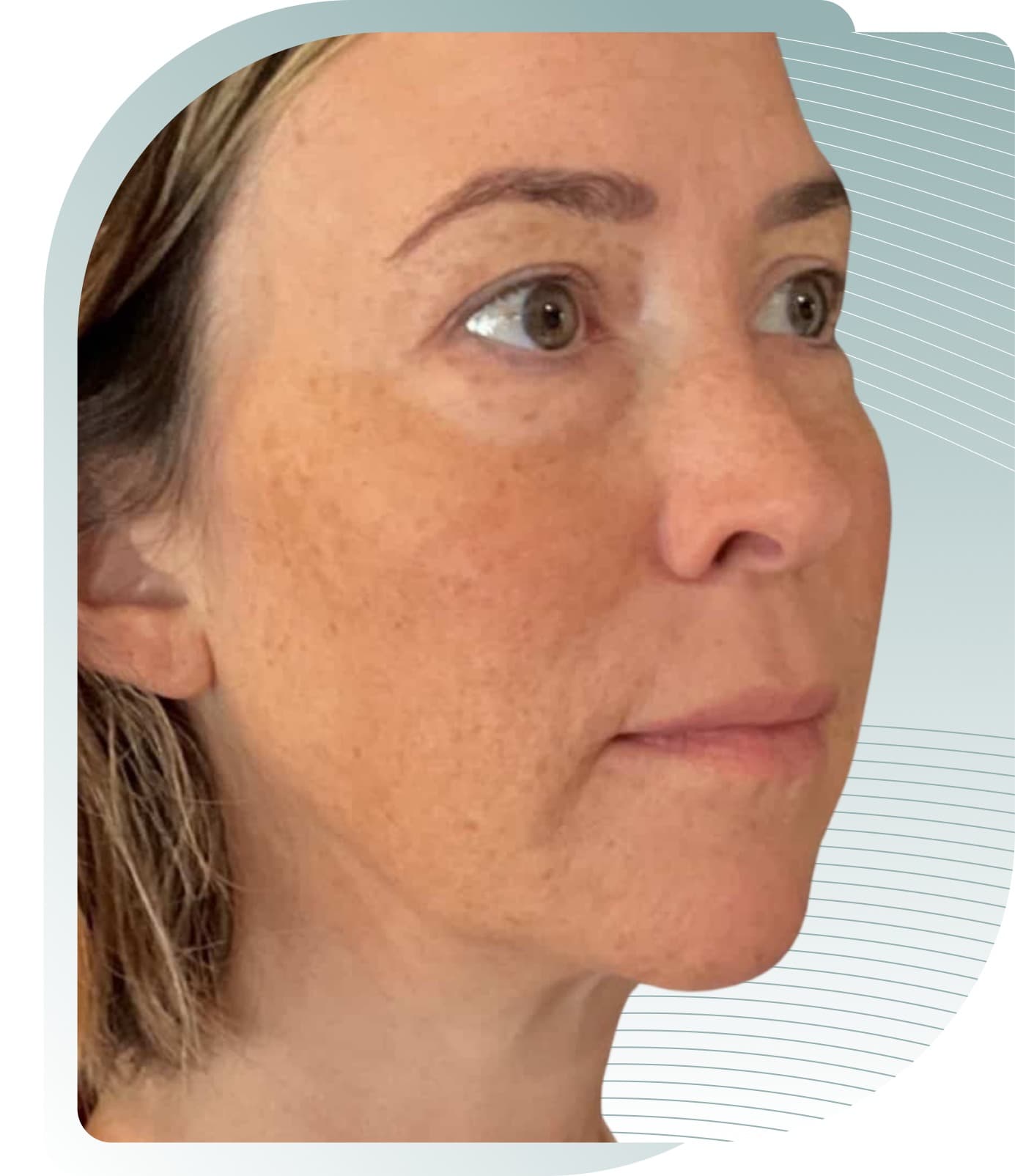 Mid-Face Rejuvenation — Before photo (result 3 of 4)