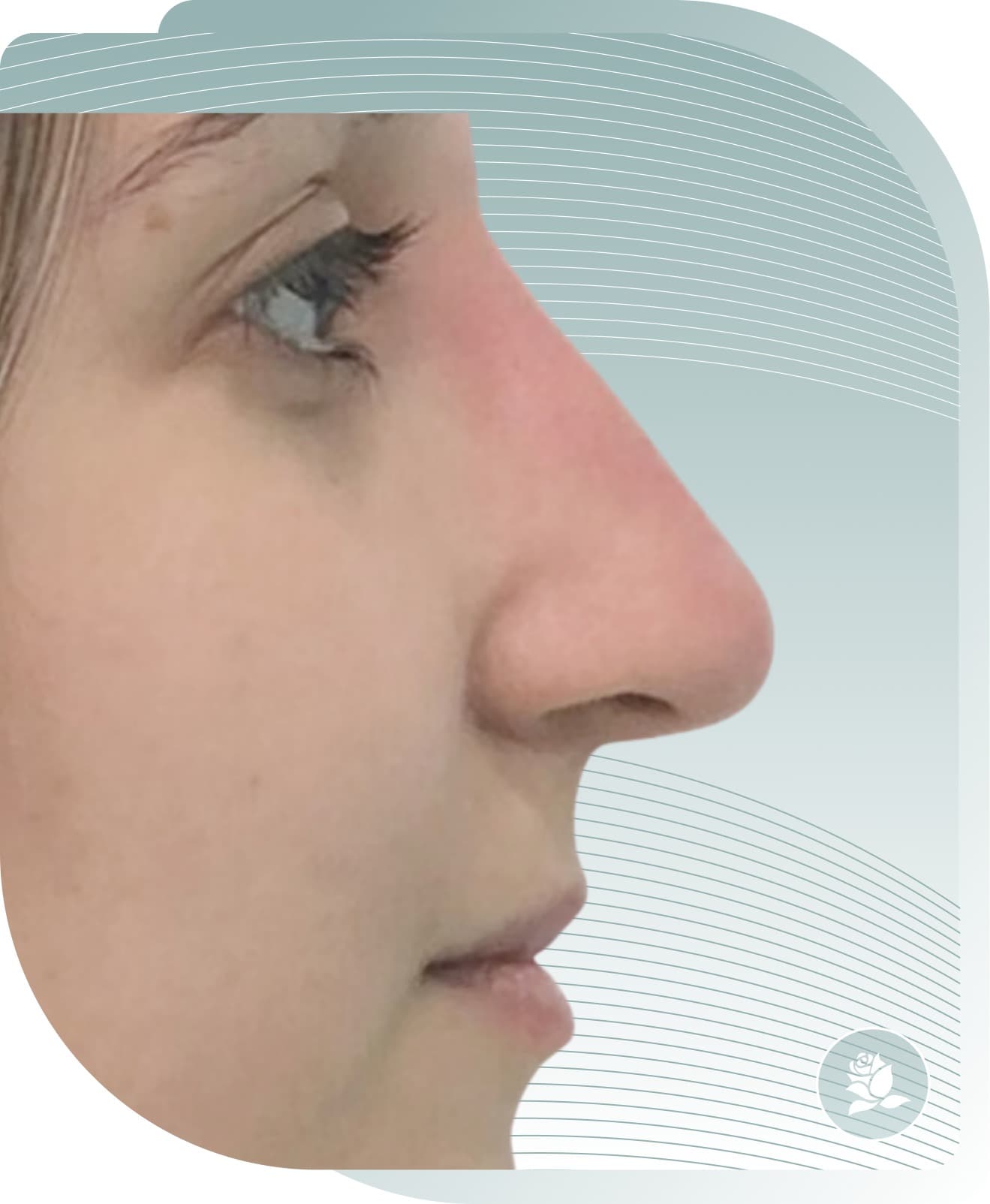 Profile Enhancement — After photo (result 4 of 4)