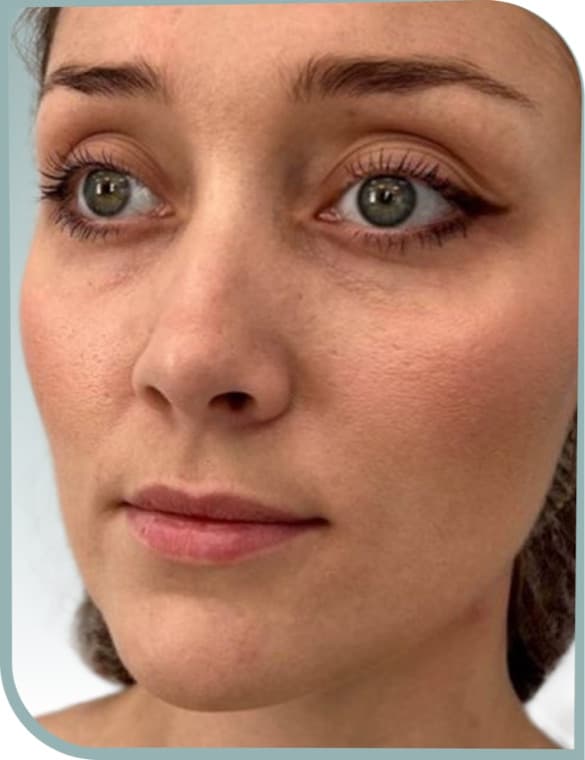 Lip enhancement, Before photo (result 6 of 10)