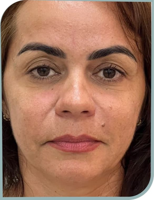 Smile line softening, After photo (result 8 of 10)