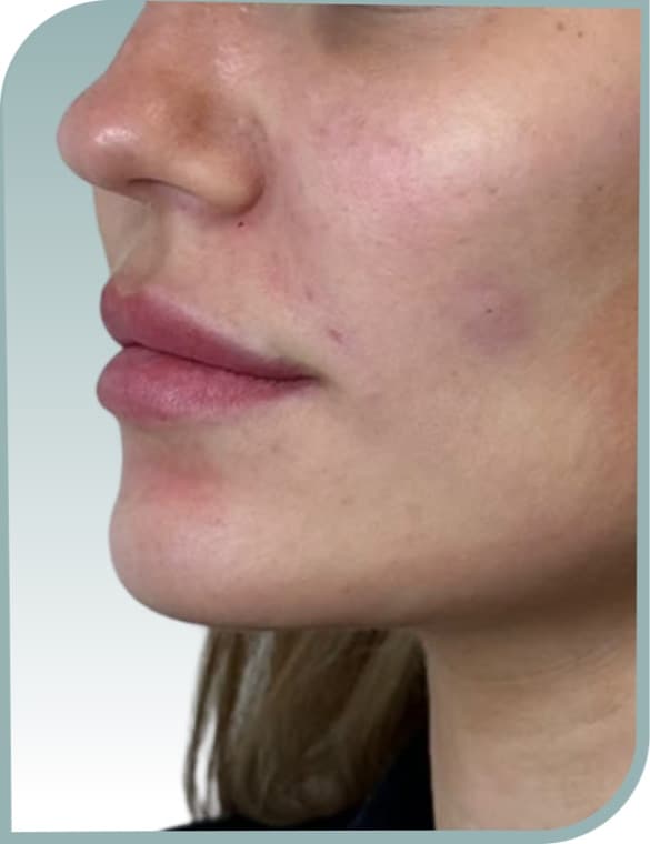 Lip profile, Before photo (result 9 of 10)