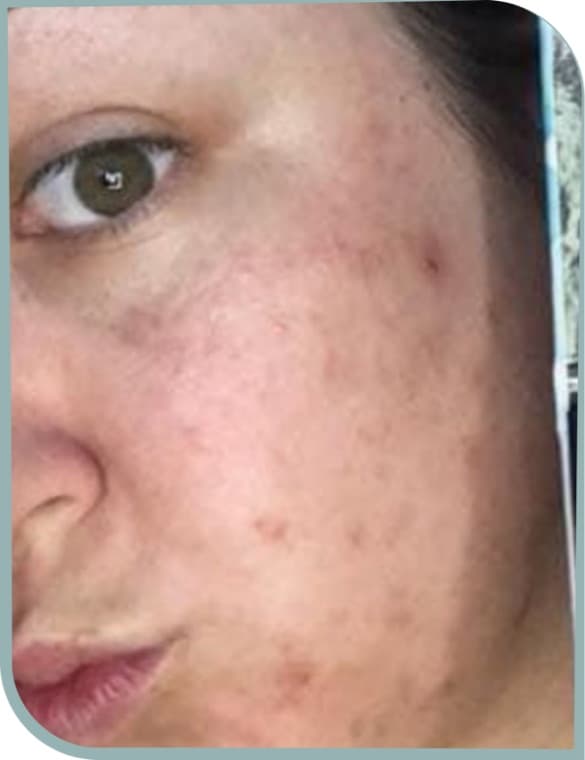 Uneven, red skin, Before photo (result 6 of 6)