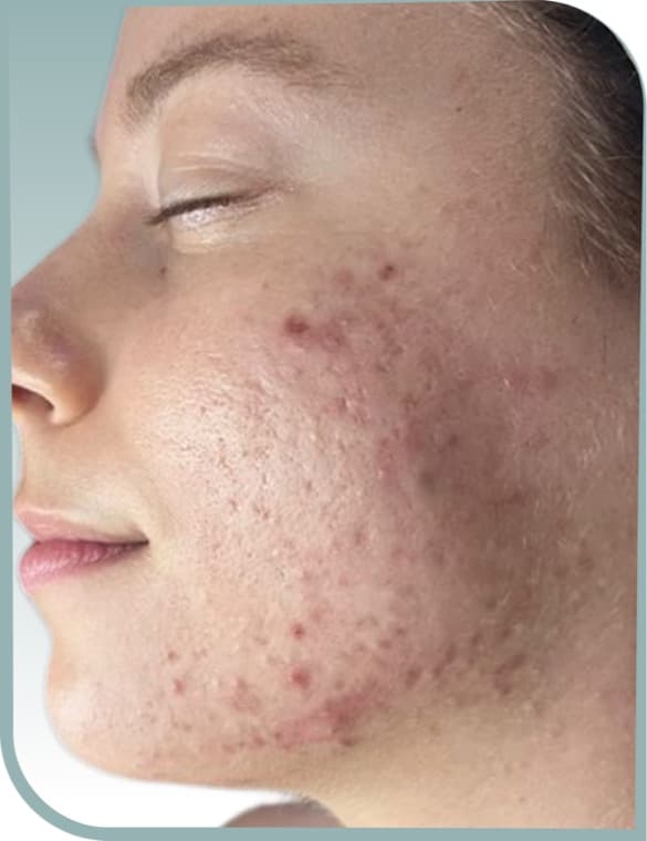 Cheek and jaw breakouts, Before photo (result 1 of 10)