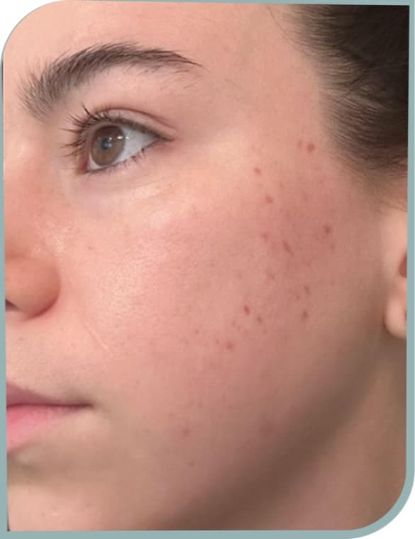 Post-acne marks, Before photo (result 9 of 10)