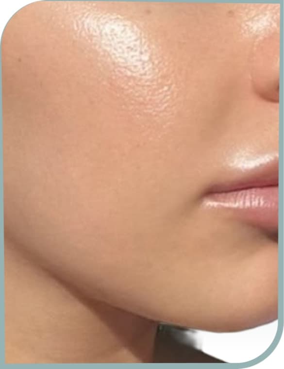 Acne scarring and texture, After photo (result 4 of 6)
