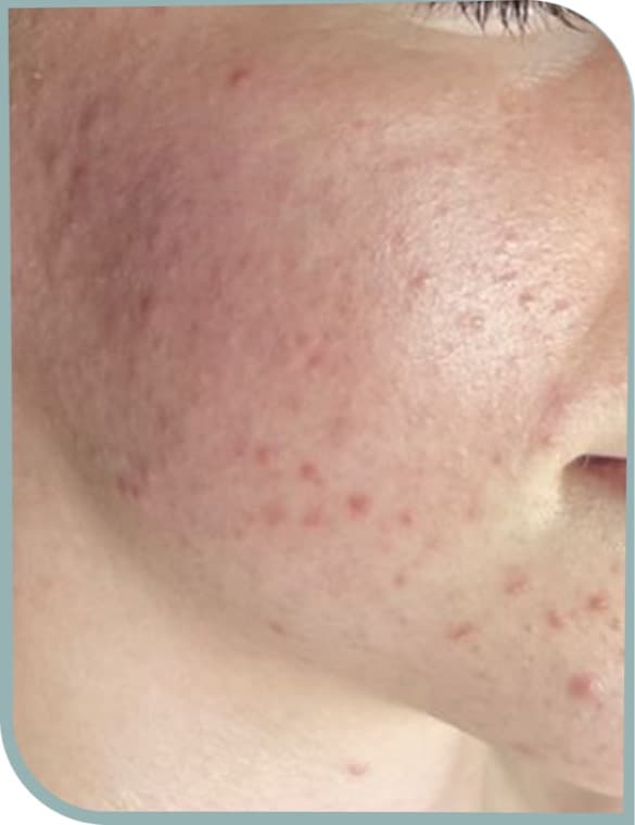 Cheek redness, Before photo (result 2 of 6)