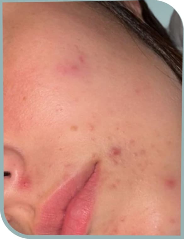 Cheek and chin acne, Before photo (result 3 of 6)