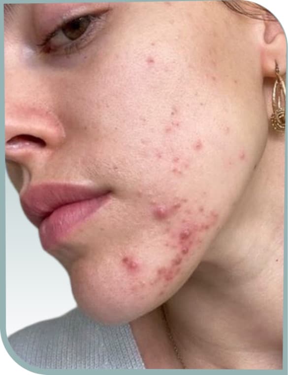 Jawline breakouts, Before photo (result 1 of 6)