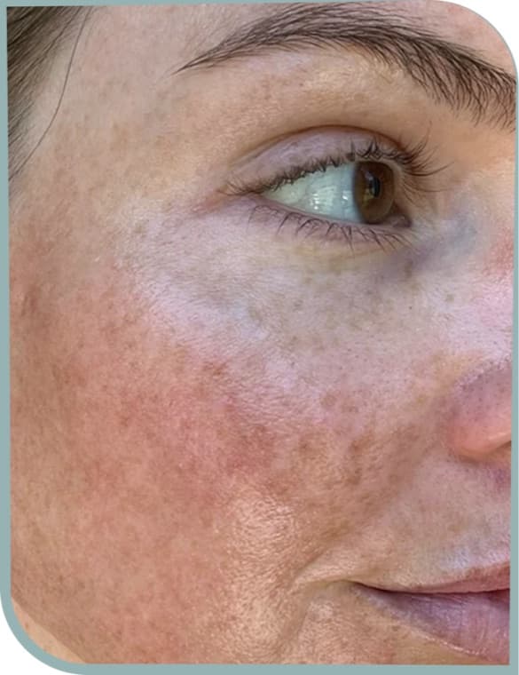 Cheek pigmentation, Before photo (result 2 of 10)