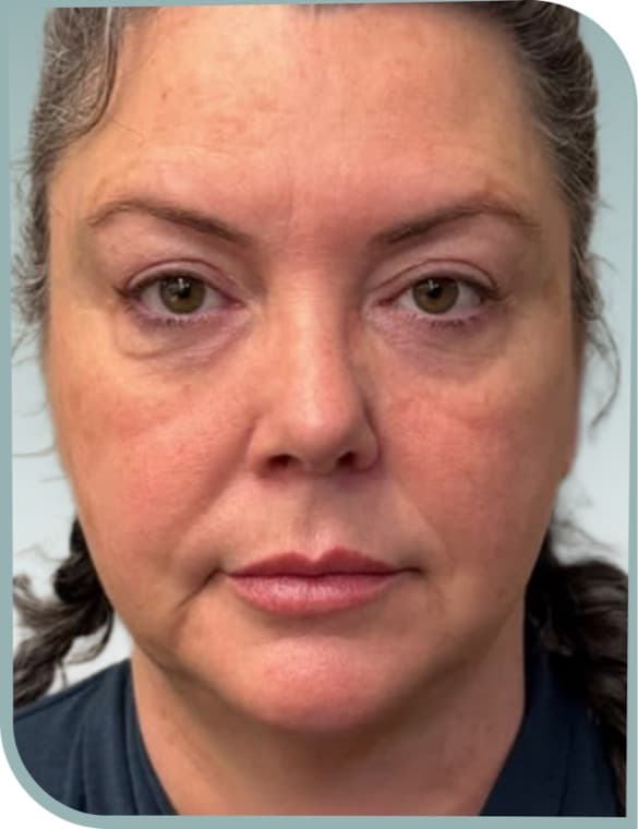 Dull, tired skin, Before photo