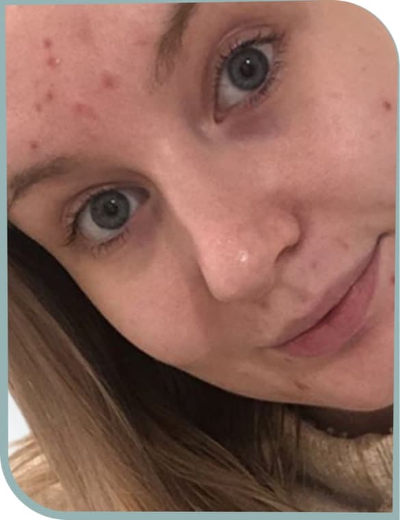 Forehead breakouts, Before photo