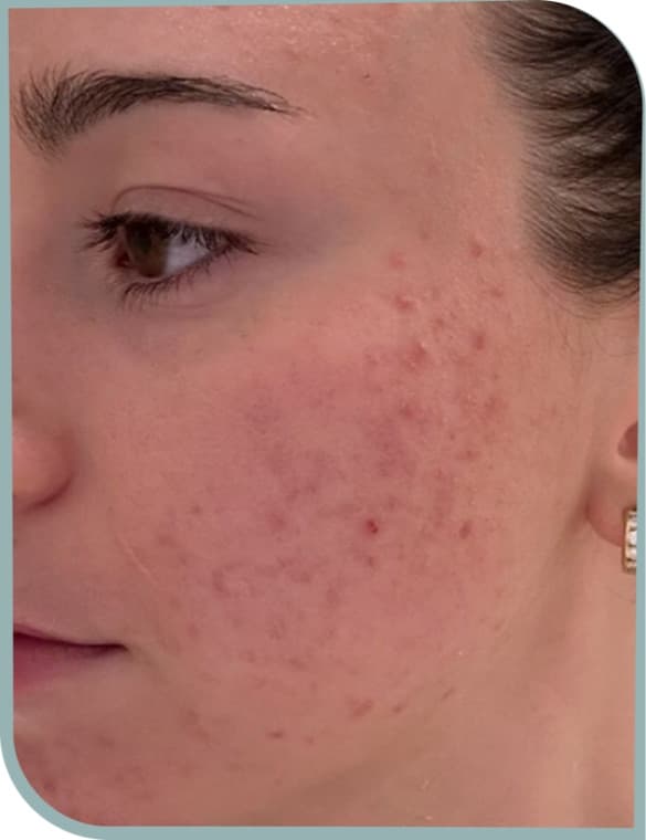 Jawline breakouts, After photo (result 1 of 6)