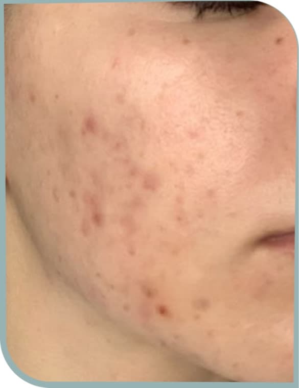 Acne scarring and texture, Before photo (result 8 of 10)