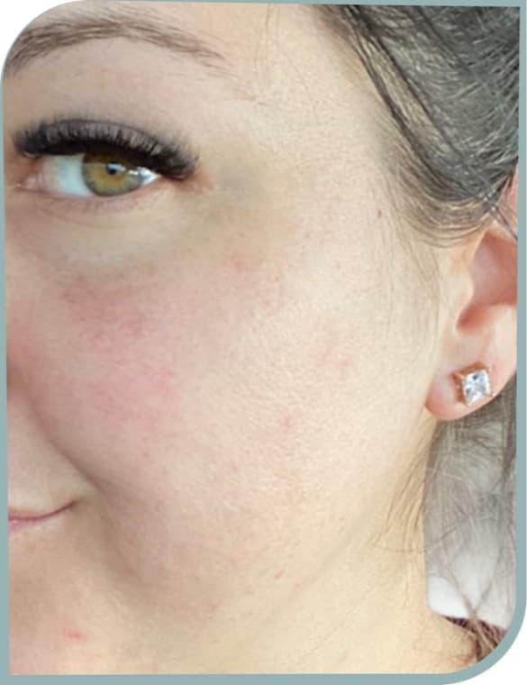 Uneven, red skin, After photo (result 6 of 6)