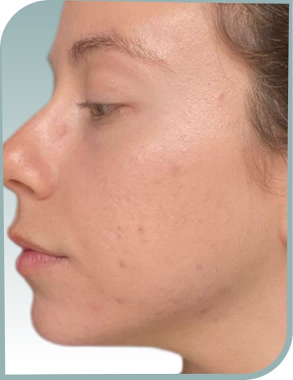 Cheek and jaw breakouts, After photo (result 1 of 10)