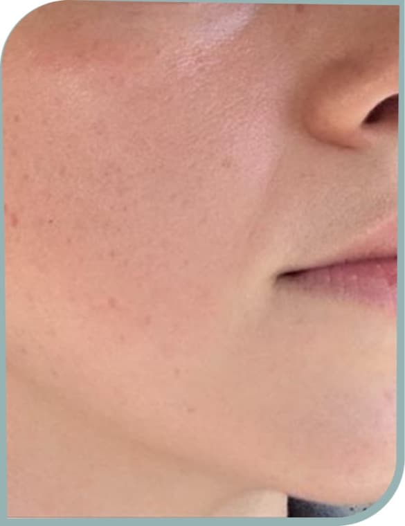 Cheek redness, After photo (result 6 of 10)