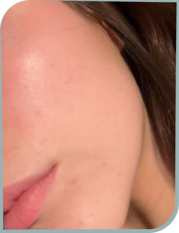 Cheek and chin acne, After photo (result 7 of 10)